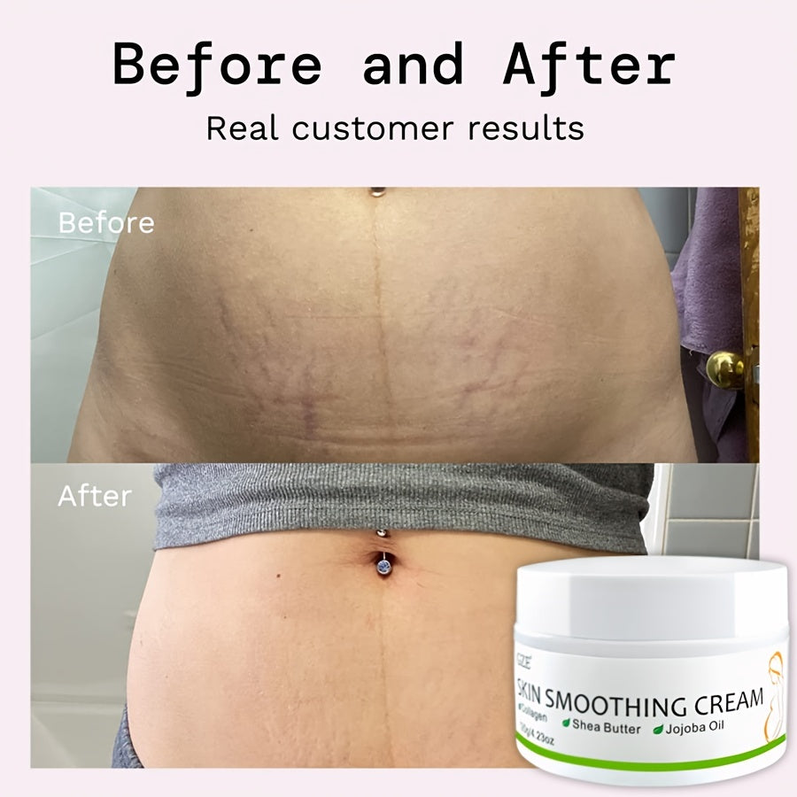 GZE Skin Smoothing Cream: Say Goodbye to Stretch Marks with our Natural Pregnancy Stretch Mark Cream - Suitable for All Skin Types