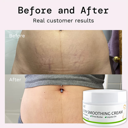GZE Skin Smoothing Cream: Say Goodbye to Stretch Marks with our Natural Pregnancy Stretch Mark Cream - Suitable for All Skin Types